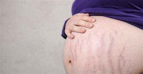 一般怀孕几个月有妊娠纹出现