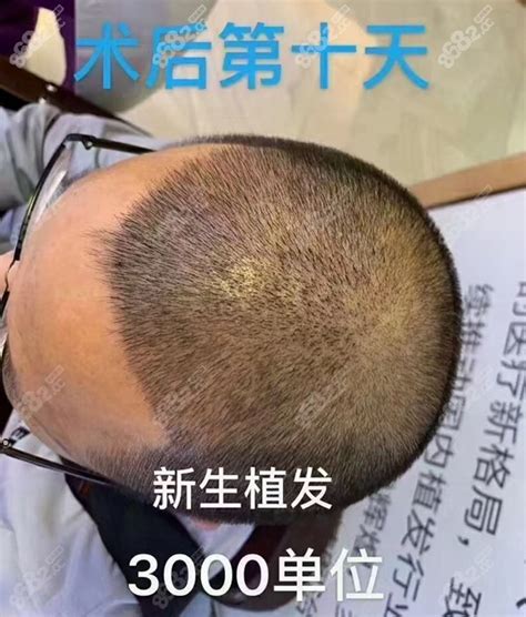 上海医院毛发种植
