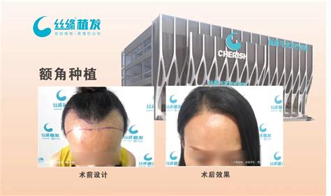 中国最好毛发种植医院