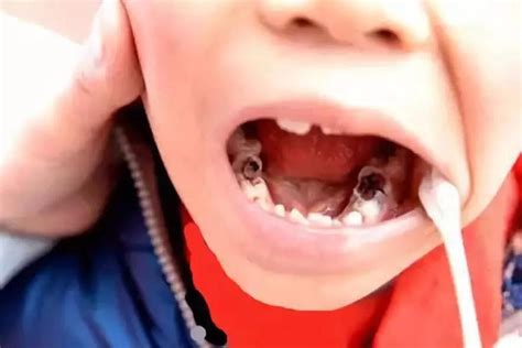 儿童智齿多长时间检查一次