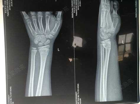 六岁女孩左手骨折术后手伸不直
