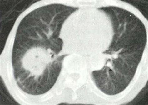 右肺中心型肺癌