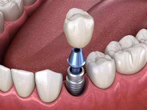 固定义齿修复与种植牙