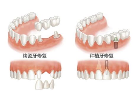 固定义齿和种牙哪个痛苦