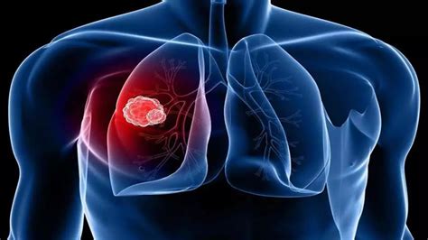 在中国为什么肺癌是第一高发癌症