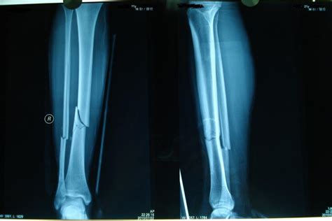 大腿骨折一个月后做手术