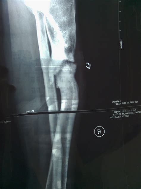 大腿骨折做手术五个月又痛