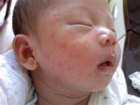 婴儿高热出疹子后的禁忌