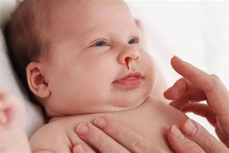 小孩流鼻血是什么原因