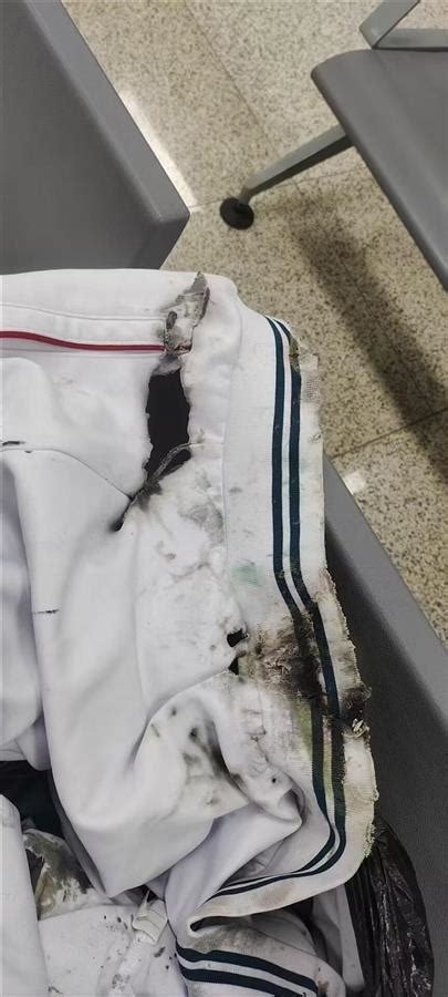 广州地铁内男孩被硫酸灼伤