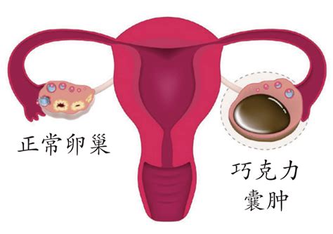 引产后子宫囊肿