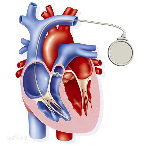 心脏助搏器图片