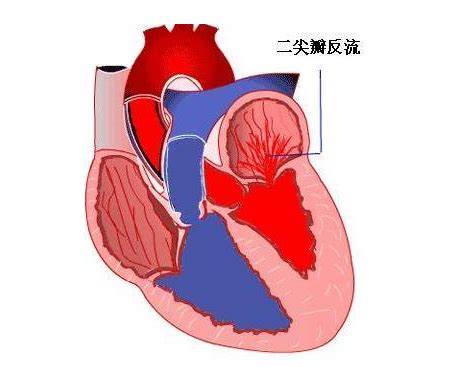 心脏反流是怎么造成的