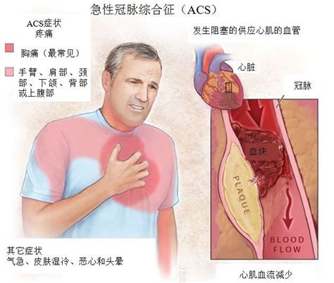 急性冠脉综合征包括哪三种