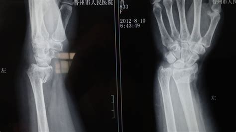 手腕骨折50天能恢复到啥程度