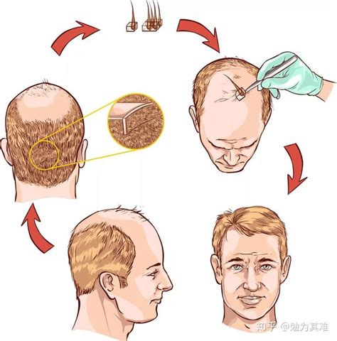 植发原理和过程图解