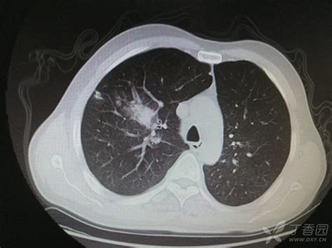 正常的肺片子图片
