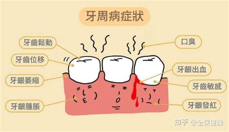 牙周病牙齿全掉光会影响生命吗