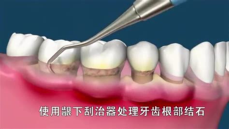 牙周病牙龈出血怎么治疗