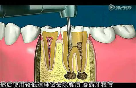 牙齿根管治疗全过程