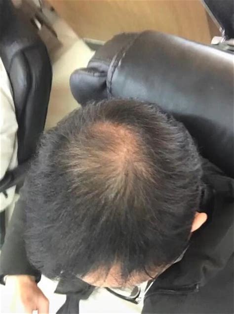 男子秃顶半月不用洗发水长出新发