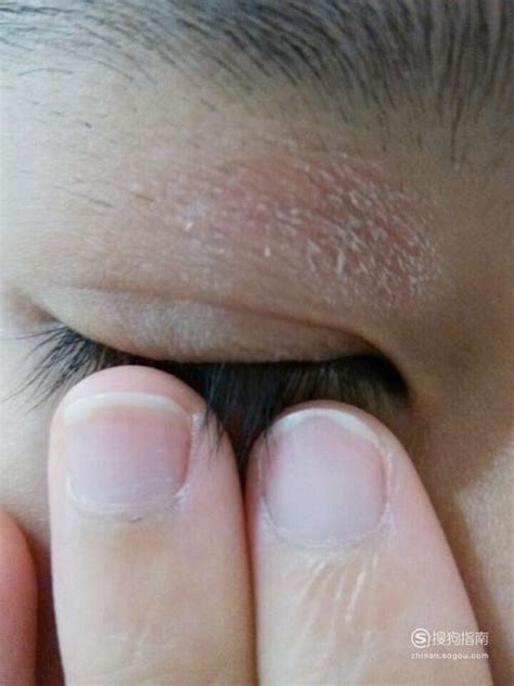 眼周皮肤老是过敏是怎么回事