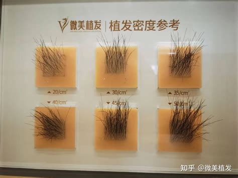 种植毛发技术得多少钱