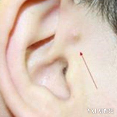 耳朵周围长痘是什么原因