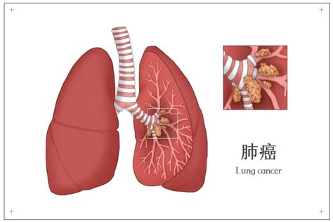 肺癌为什么是发病最高的癌症