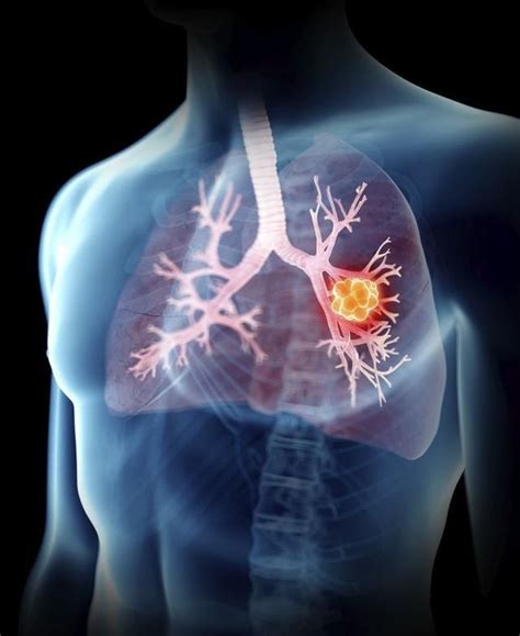 肺癌成为全球新增病例数最多癌症