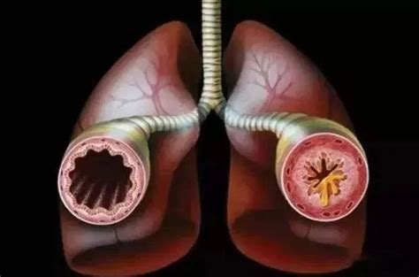 肺部感染会自愈吗