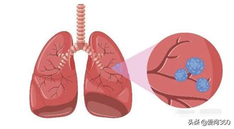 肺部结节是怎么回事