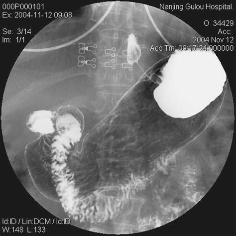 胃部瘤手术 引流图片