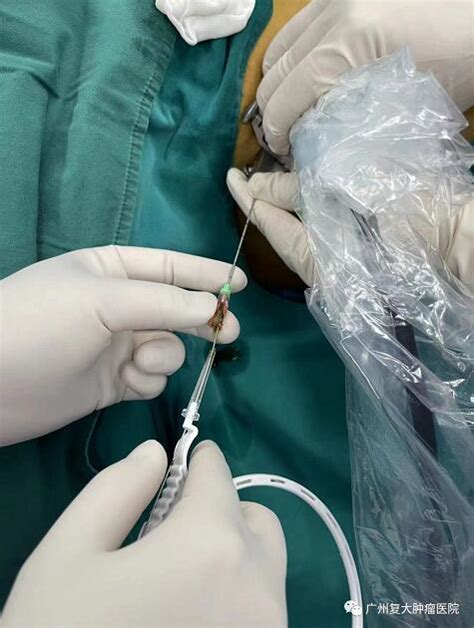胆管引流手术流程