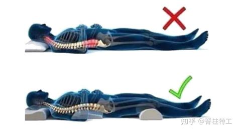 脊椎弯曲最佳睡姿图