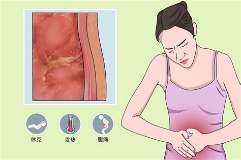 腹腔转移的症状是什么
