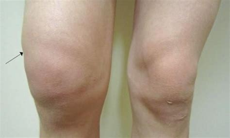 膝关节有积液能戴护膝