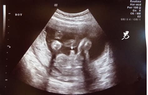 17周胎儿b超图
