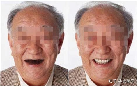 75岁老人可种牙吗