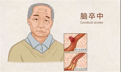 85岁老人脑梗狭窄90%放不放支架