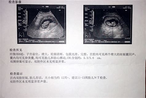 b超单怎么看胎儿性别图片数据