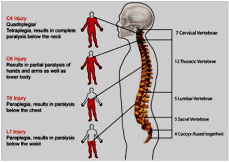 central pain syndrome