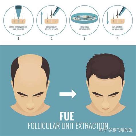 fut种植头发的原理