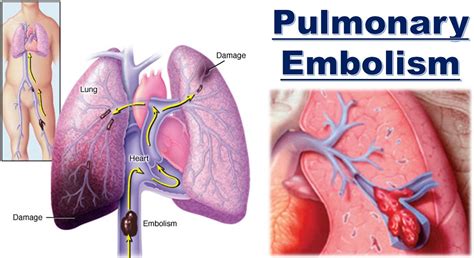 pulmonary thrombosis
